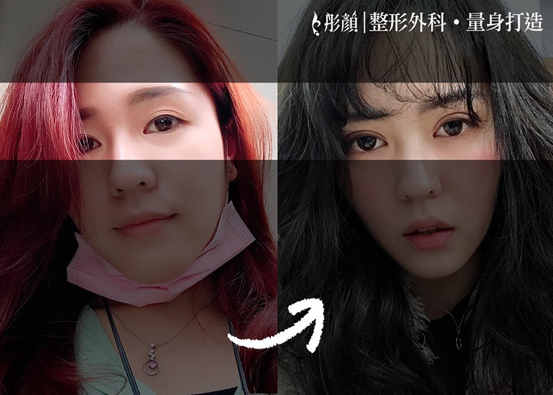 彷彿天生！後悔沒早做「訂書針雙眼皮」打造夢寐以求的明亮電眼~整形外科 劉宏貞醫師,大小眼,眼摺不對稱