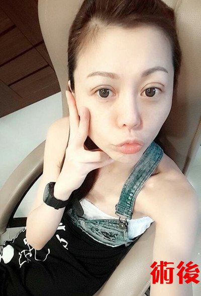 linda400術後
