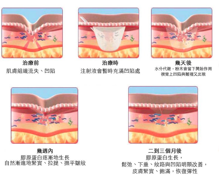 舒顏萃sculptra3D聚左旋乳酸塑然雅童顏針淚溝液態拉皮作用舒顏萃價格費用07.jpg