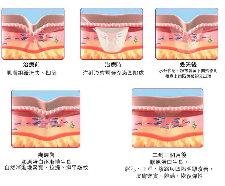 舒顏萃sculptra3D聚左旋乳酸塑然雅童顏針淚溝液態拉皮作用舒顏萃價格費用07.jpg