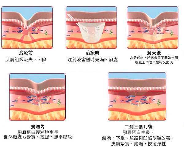 Ellanse-Sculptra-AestheFill-which-better