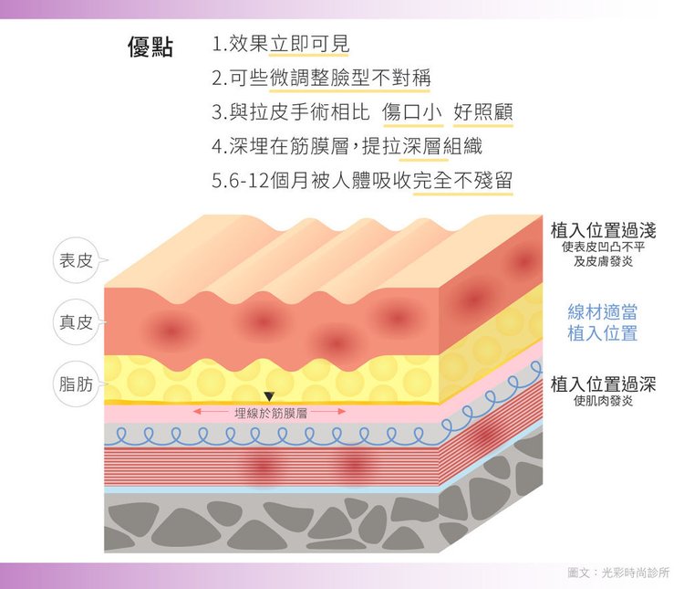 埋線拉提失敗埋線拉提費用埋線拉提副作用埋線拉提ptt埋線拉提推薦埋線拉提後遺症埋線拉提術後埋線拉提恢復期臉部埋線拉提費用中醫埋線拉提雙下巴醫美雙下巴拉提雙下巴運動下顎線拉提下顎線輪廓線臉部埋線費用.jpg