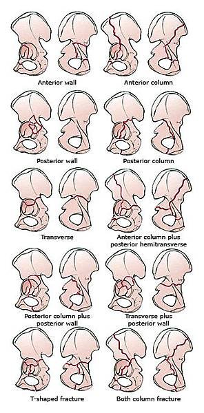 Acetabular_fx_scheme.jpg