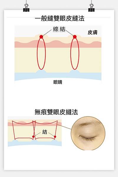 【真】無痕縫雙眼皮 x 隱形提眼肌：看不到線結，摸不到綫結，表面無痕跡的雙眼皮x 提眼肌縫法