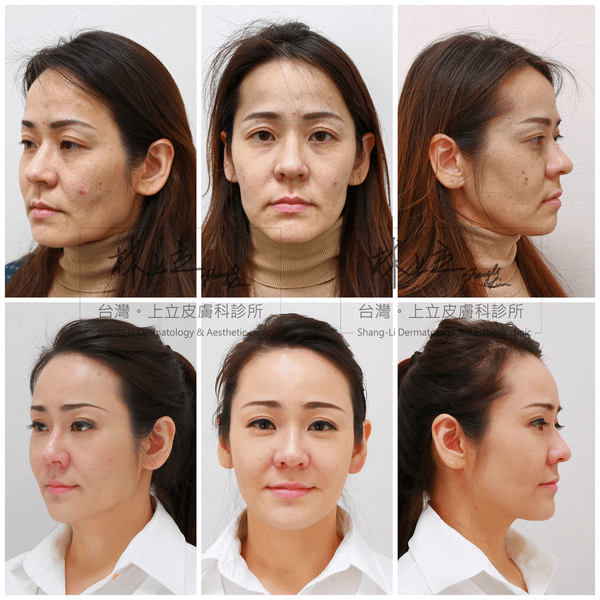 液態拉皮上立提膠原增生劑洢蓮絲舒顏萃童顏針少女針3D聚左旋乳酸sculptra依戀詩ellanse林上立醫師3.png
