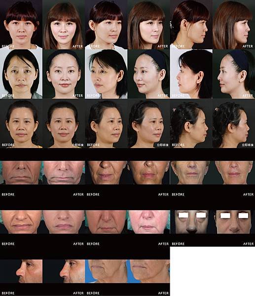【玻尿酸 】我在iskin你呢？最高CP值微調美麗