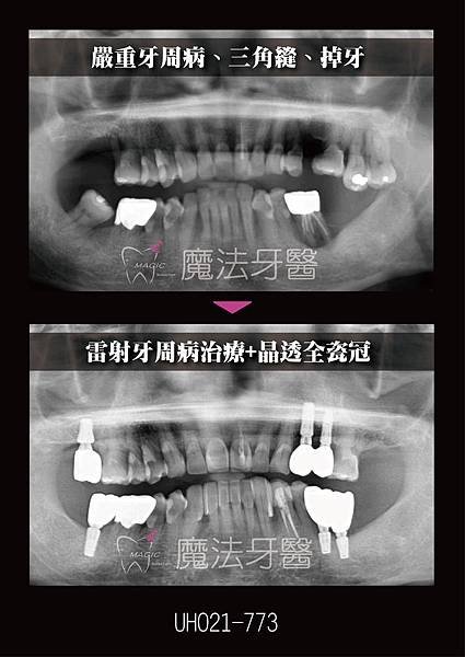 以水雷射治療牙周病真的有效果嗎？有副作用或後遺症嗎？