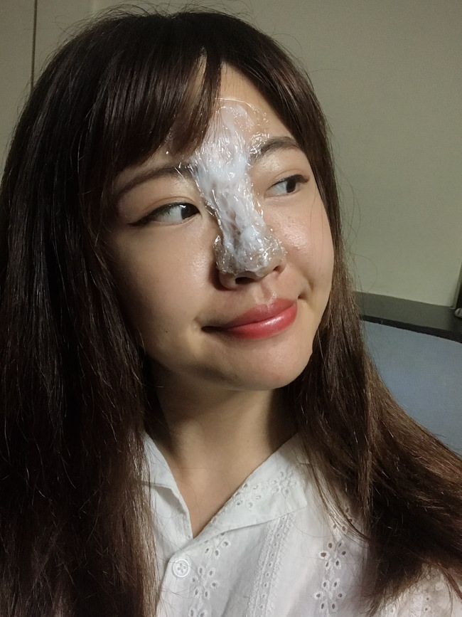 玻尿酸隆鼻推薦