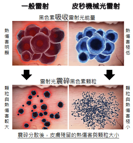 PicoSure755皮秒雷射蜂巢式聚焦陣列透鏡蜂巢透鏡皮秒雷射蜂巢皮秒雷射肝斑除斑拒絕媽媽臉04.png