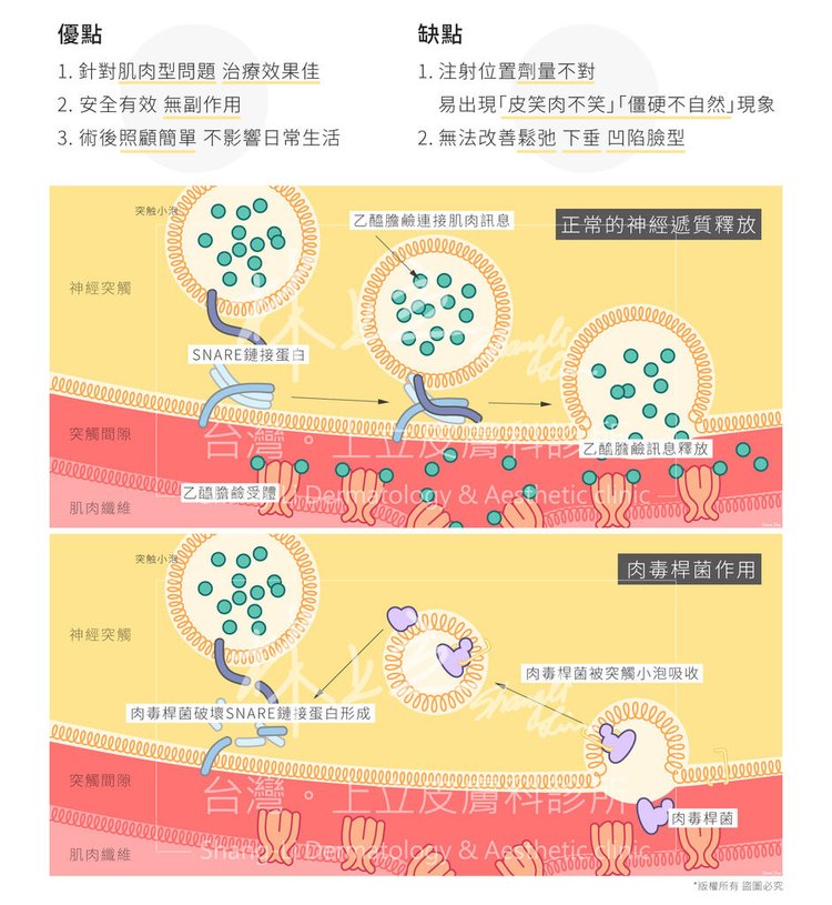 肉毒桿菌 瘦臉 肉毒桿菌 瘦臉 價格肉毒桿菌 瘦臉 副作用肉毒桿菌 瘦臉 維持肉毒桿菌 瘦臉針肉毒桿菌 瘦臉 ptt肉毒桿菌台北 肉毒桿菌推薦 (2).jpg