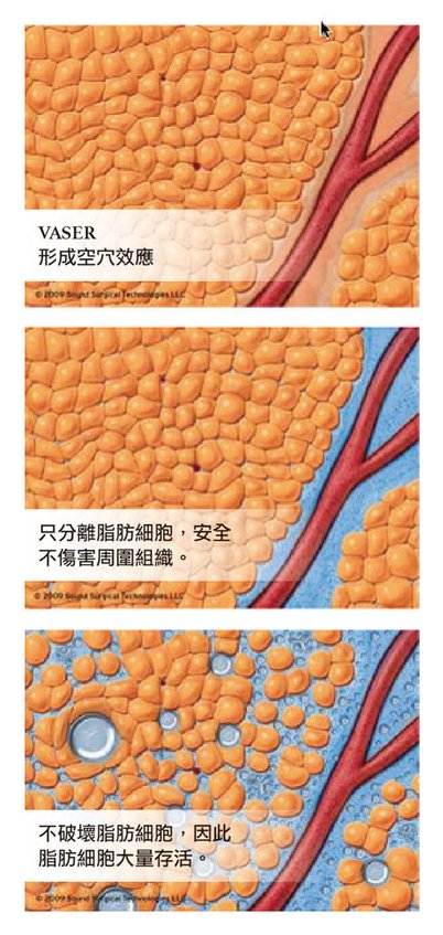 恢復期變短 VASER威塑抽脂連港澳都風靡  - 蘋果日報採訪李兆翔醫師2.jpg