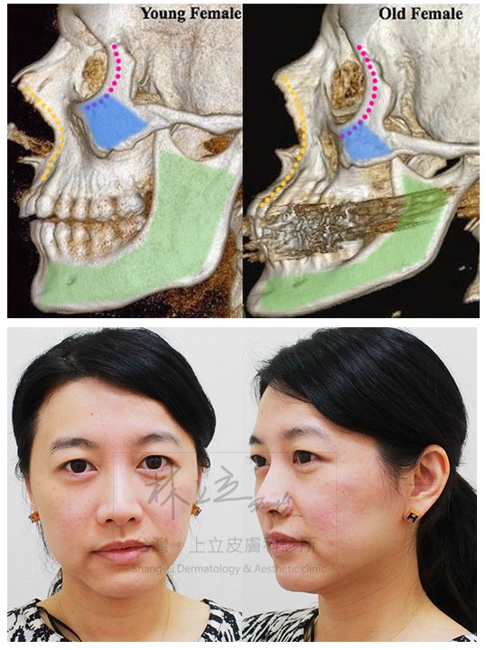 液態拉皮上立提Ellansé 洢蓮絲少女針PolycaprolactonePCL膠原增生劑易麗適依戀詩聚己內酯 洢蓮絲雙頰下垂蘋果肌拉提緊實03.jpg