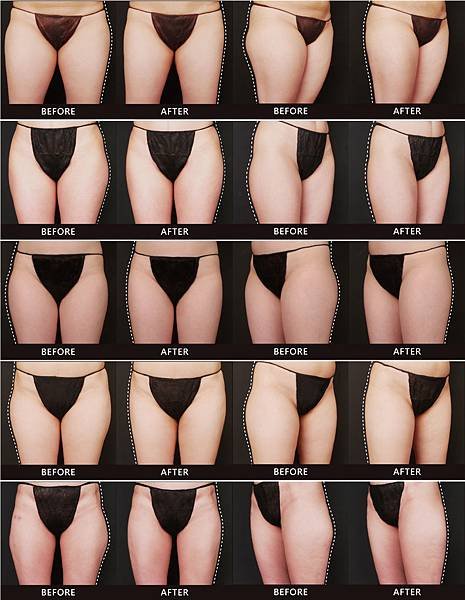 Coolsculpting-Other-03
