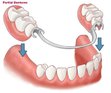 689038-partialdenture