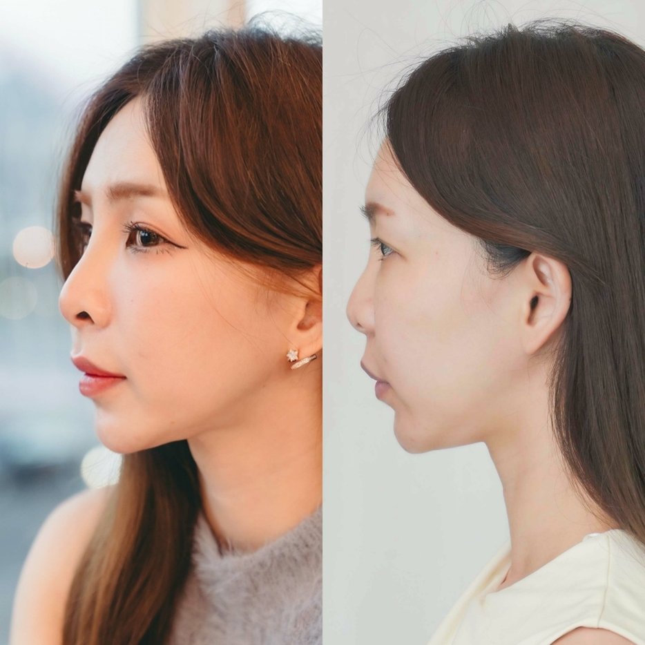 變身濃顏系美人 偷偷變漂亮秘密-美麗風尚醫學美容診所 無痕鼻