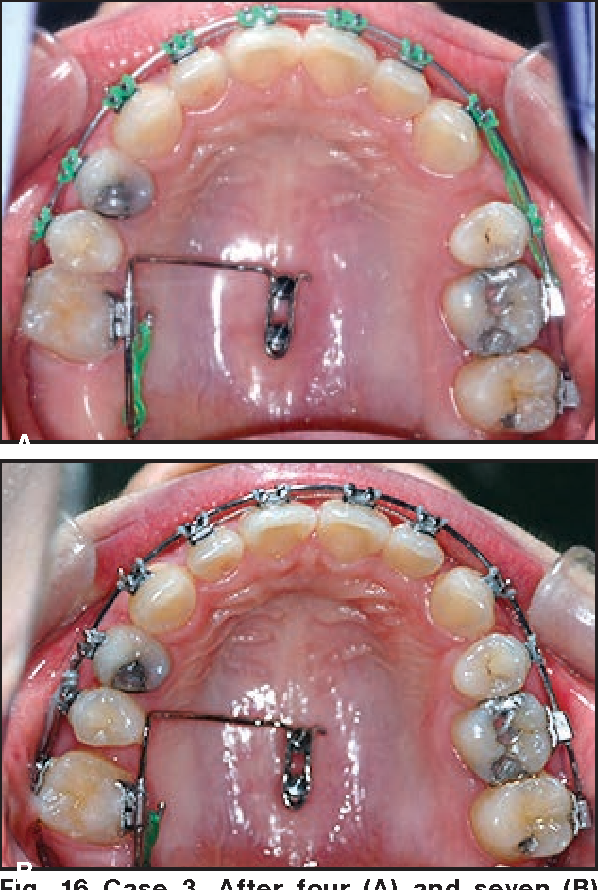 Figure 16 from The Indirect Palatal Miniscrew Anchorage and Distalization  Appliance. | Semantic Scholar