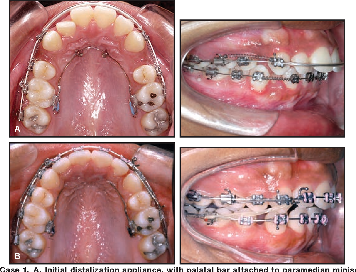 Figure 5 from The Indirect Palatal Miniscrew Anchorage and Distalization  Appliance. | Semantic Scholar