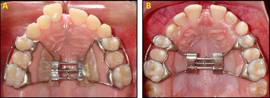 PDF] Immediate effects of rapid maxillary expansion with Haas-type and hyrax-type expanders: a randomized clinical trial. | Semantic Scholar