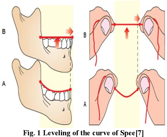 PDF] Evaluation of the Depth of the Curve of Spee, Overjet, and Overbite in  Class I, Class II, and Class III Malocclusion Among Patients at University  of North Sumatera Dental Hospital |