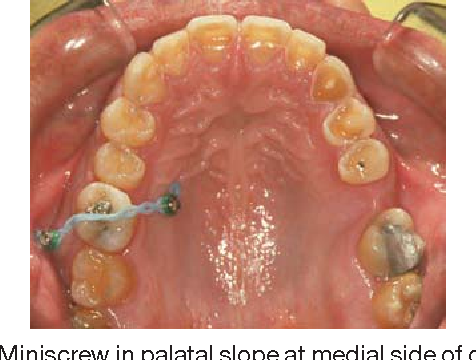 Figure 3 from Risks and complications of orthodontic miniscrews. | Semantic  Scholar