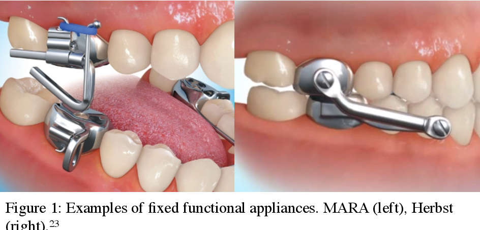 Figure 1 from Comparison of treatment effects of the Forsus Fatigue  Resistance Device in Class II patients with different underlying vertical  skeletal patterns | Semantic Scholar