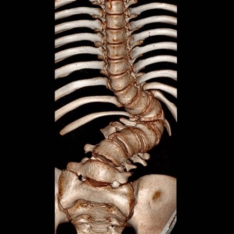 01_陳小弟手術前脊椎3D圖，脊椎側彎角度超過100度.jpg