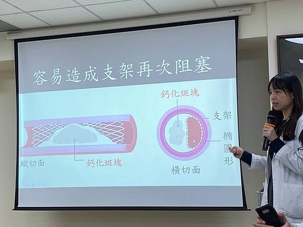 IVL血管內震波碎石術3大優勢 改善患者血管嚴重鈣化問題