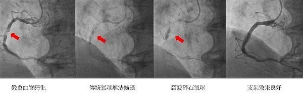 患者採氣球擴張術未能有效撐開鈣化病灶，後接受IVL治療順利植入支架.jpg