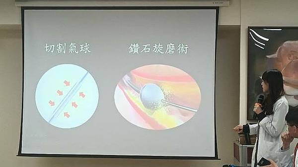 IVL血管內震波碎石術3大優勢 改善患者血管嚴重鈣化問題