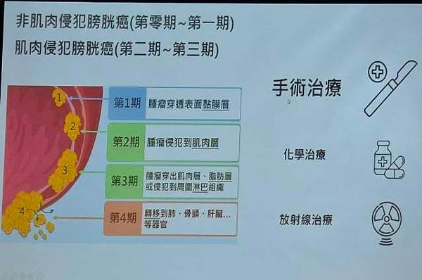 轉移性泌尿上皮癌不再是絕症	：免疫加標靶治療成功逆轉疾病