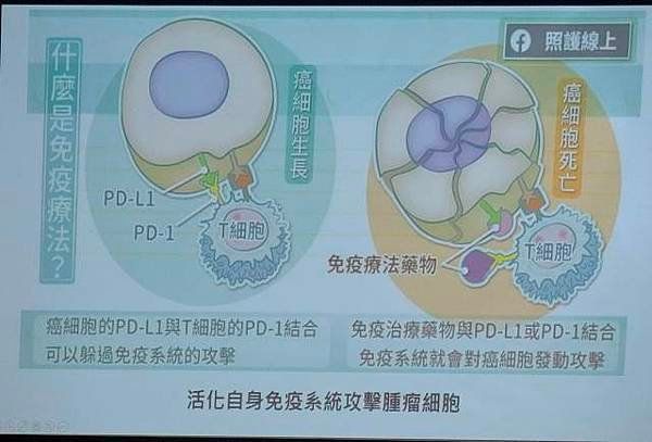 轉移性泌尿上皮癌不再是絕症	：免疫加標靶治療成功逆轉疾病