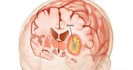glioma.jpg