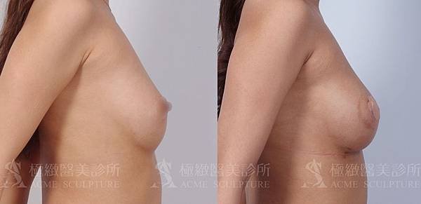 隆乳手術魔滴隆乳價錢極緻隆乳案例費用隆乳失敗自體脂肪隆乳果凍矽膠隆乳好嗎魔滴案例魔滴隆乳dcard (3).jpg