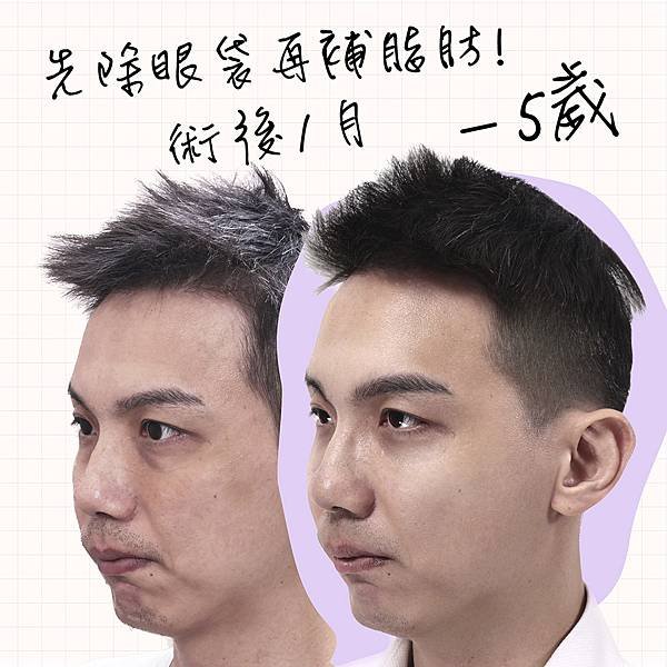 眼袋手術｜撕除老態的標籤 你可以怎麼做...?