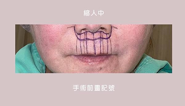 縮人中｜造成視覺老態的原因可能是這個！