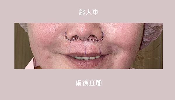 縮人中｜造成視覺老態的原因可能是這個！