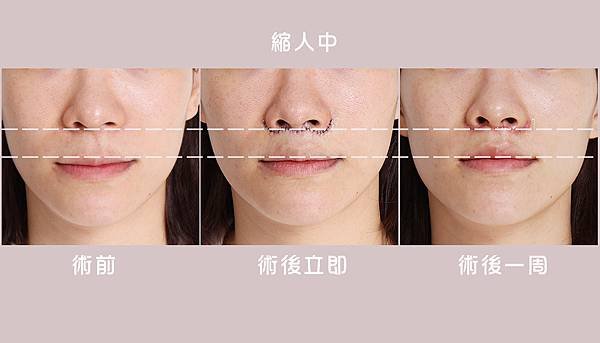 縮人中｜造成視覺老態的原因可能是這個！