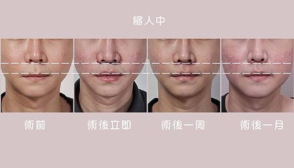 縮人中｜造成視覺老態的原因可能是這個！
