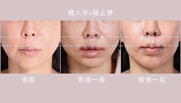 縮人中｜造成視覺老態的原因可能是這個！
