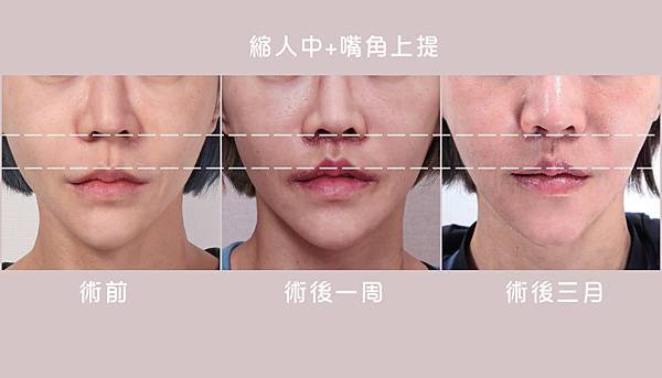 縮人中｜造成視覺老態的原因可能是這個！