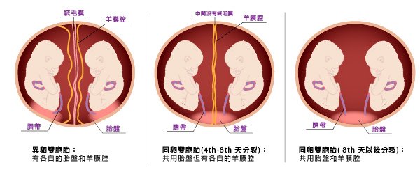 雙胞胎/多胞胎生產，同卵、異卵雙胞胎形成原因