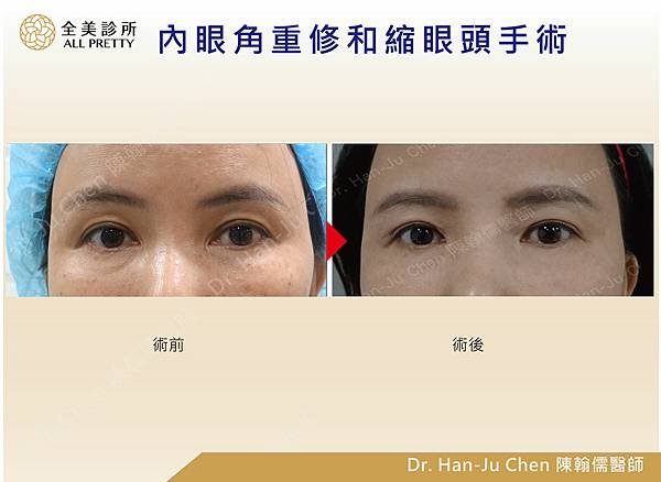 20210107-荷娜內眼頭修復+修疤.jpg