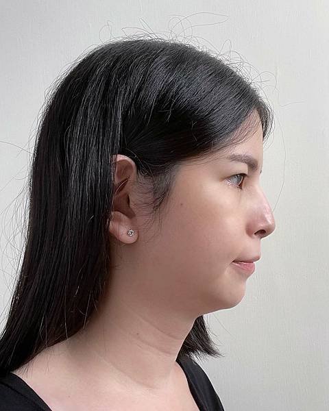 服務體驗 台中 美加健康醫美集團 消脂針 雙下巴 1.jpeg