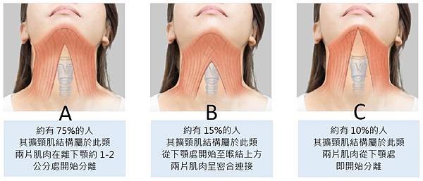 雙下巴成因和闊頸肌有關