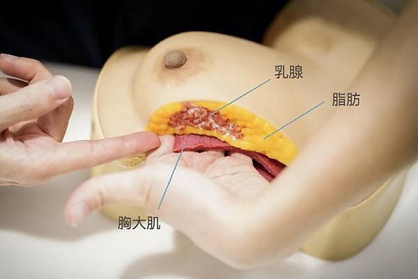 乳癌切除的部分為乳房內的乳腺組織