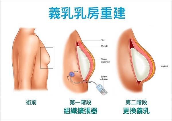 乳房重建前使用組織擴張器擴張乳房