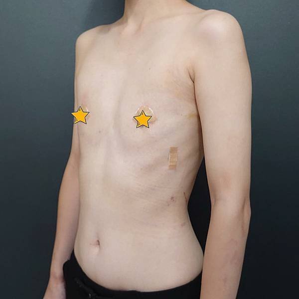 平胸手術做乳暈上切口重新定位乳頭位置，術後效果自然