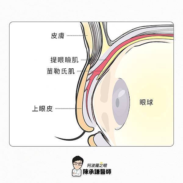 提眼瞼肌手術術後效果失敗，可能跟沒做雙眼皮手術有關