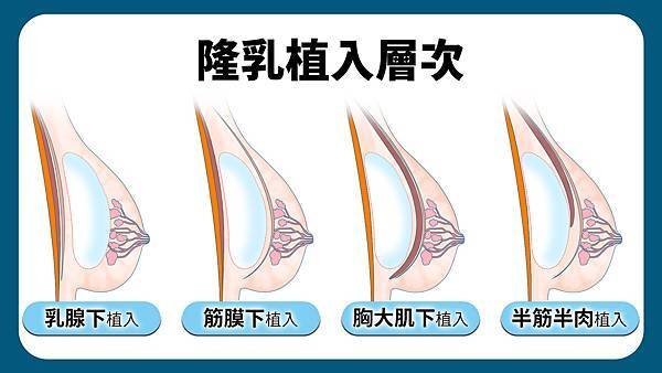 隆乳假體放在胸大肌下或者半筋半肉的層次會在術後感到疼痛感較明顯