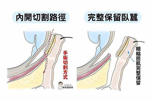 想消除輕度結構型黑眼圈，可藉由眼袋內開手術，路徑完全不會碰到臥蠶